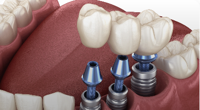 Multiple Tooth Implant Illustration