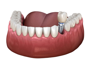 Single Tooth Implant Illustration