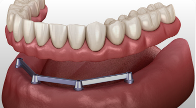 Implant Supported Denture Illustration