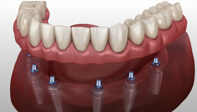 All-on-X Implant Illustration